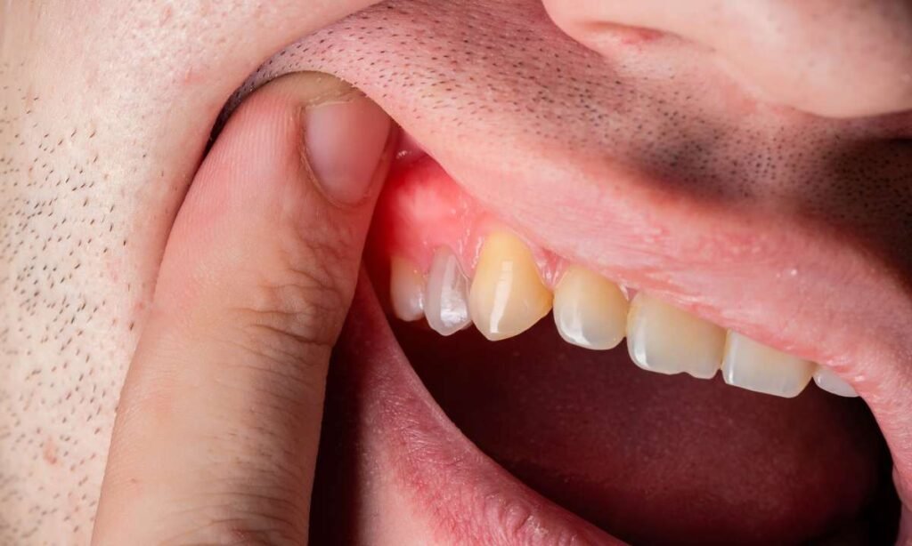 Damage Teeth and Gums