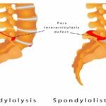 Understanding Spondylolisthesis: Causes, Symptoms, and Treatment Options