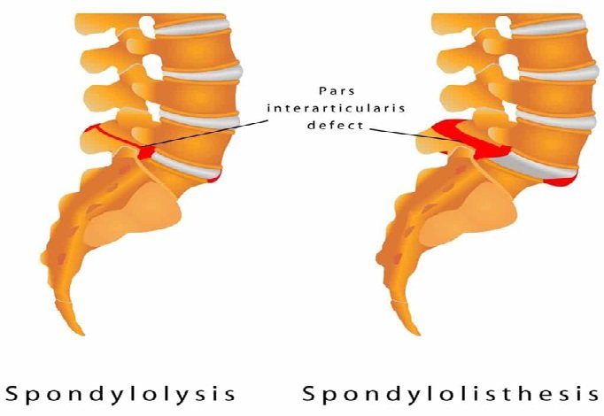 Understanding Spondylolisthesis: Causes, Symptoms, and Treatment Options