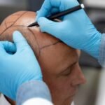 Hair Transplant Solutions