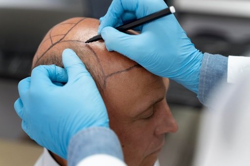Hair Transplant Solutions