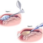 Top-Rated Hernia Surgeons