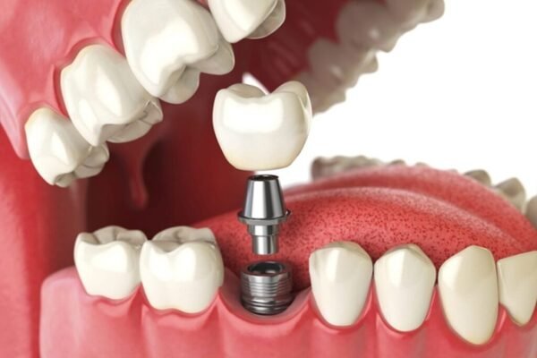 Everything To Know Before Pursuing Dental Implants