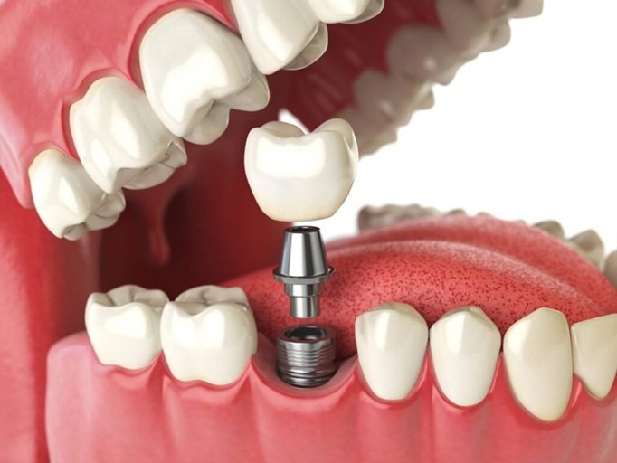 Everything To Know Before Pursuing Dental Implants